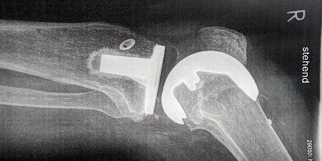 Röntgenaufnahme einer Prothese