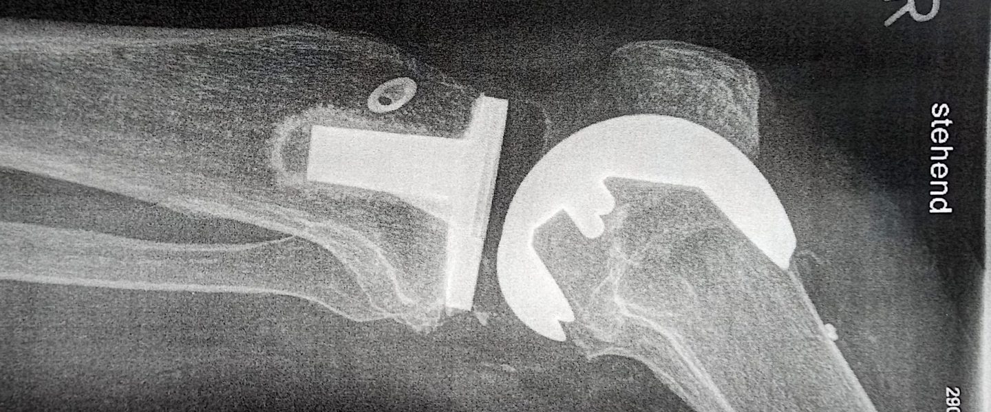 Röntgenaufnahme einer Prothese